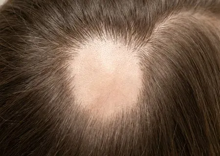 Alopecia Areata