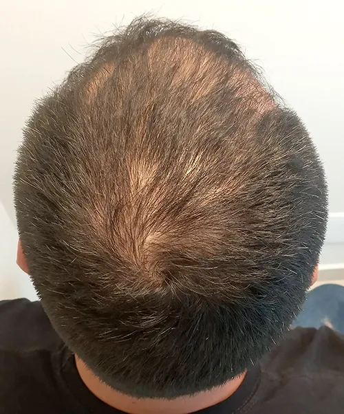 Antes do tratamento capilar - Caso 2