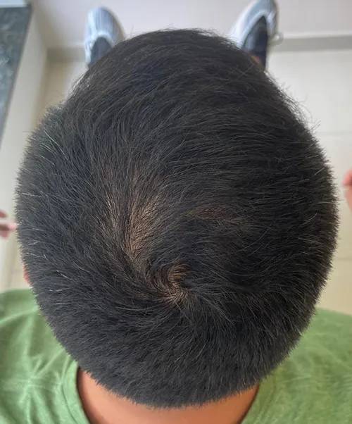Resultado do tratamento capilar - Caso 2