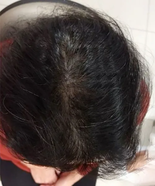 Resultado do tratamento capilar - Caso 3