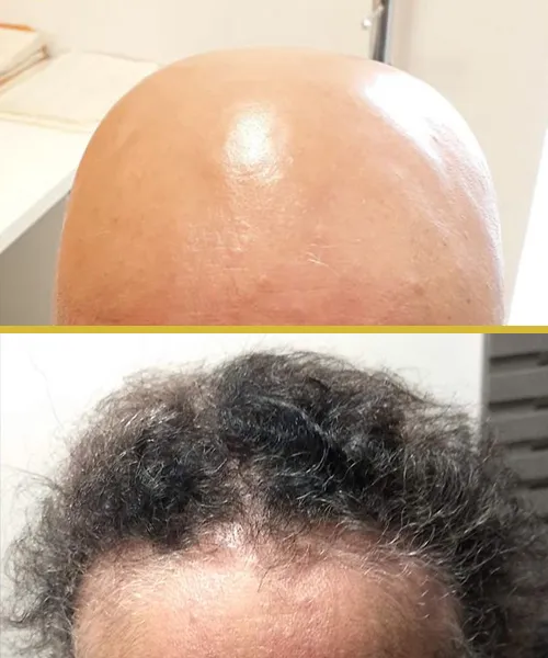 Antes do tratamento capilar - Caso 8